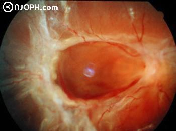 Diabetikus proliferatív retinopátia