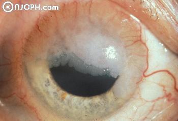 conjunctival sessile papilloma)