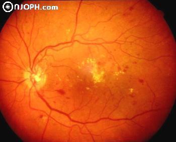 retinopatia diabetica proliferativa)