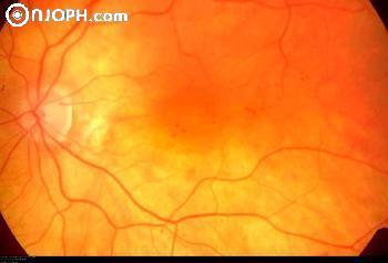 retinopathia diabetica