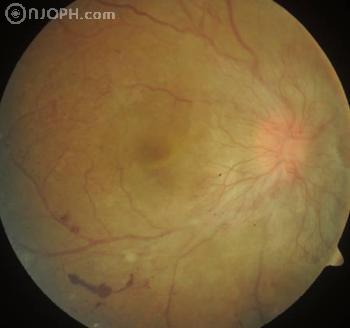 Diabéteszes retinopátia tünetei és kezelése