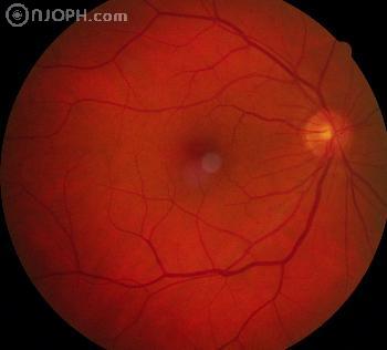 retinopathia diabetica non proliferativa)