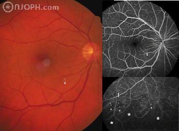 Diabéteszes retinopátia tünetei, okai, jelei, megelőzése, kezelése, gyógyítása