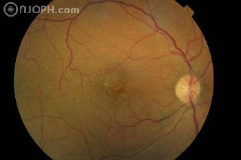 venous stasis retinopathy