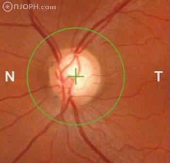 Tomografia in coerenta optica (OCT) – mai mult decat o simpla poza a retinei | schneiderturm.ro