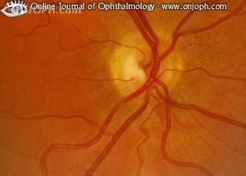Аномалия развития зрительного нерва. Гипоплазия зрительного нерва. Гипоплазия диска зрительного нерва. Гипоплазия зрительных нервов.