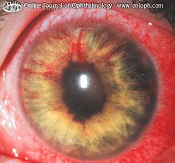 Diabeteses retinopathia, diabeteses retinopathia alapja, a diabeteses retinophatia kezelése